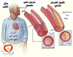 نتيجة بحث الصور عن صورة توضح انسداد الشرايين