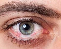 Gambar Penyakit mata