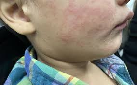New measles case in Wellington - Health NZ
