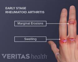 Image of Rheumatoid arthritis hand