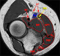 MRI of the Elbow:Current Concepts