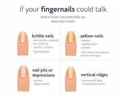 Iron deficiency nails
