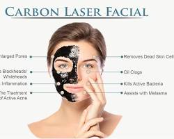 Image of Carbon laser treatment wrinkles