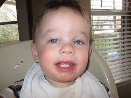 Image of a little boy with Hand, Foot, and Mouth Disease - hand-foot-mouth