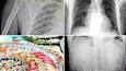 Image result for ‫بدن پر از کرم مرد چینی بخاطر تغذیه اشتباه!+عکس‬‎