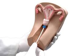 Image result for IUD image