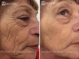 Image result for erase cosmetics