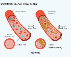 normal blood vessel and a blood vessel with cholesterol buildupの画像