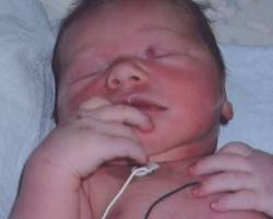baby with cyanosis