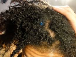 Image result for oily scalp