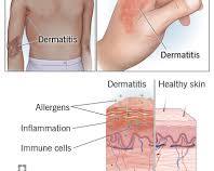 Atopic dermatitis treatmentの画像