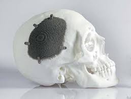 Stroke patient gets life back with 3D printed cranial ...