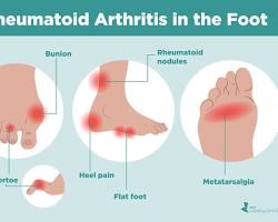 Image of Arthritis in foot