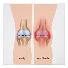 Image result for hemophilia patients