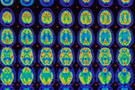 Image result for alzheimer's brain