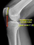 Patellar Instability - Sports - m