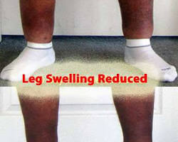 Swollen ankles and feet due to obesity
