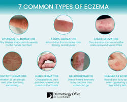 Dry skin vs. Atopic dermatitisの画像