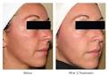 Rosacea ipl