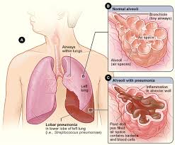 Ciri Penyakit Paru-Paru Lembap (Pneumonia)