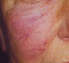 como eliminar rosacea facial
