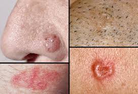 Image result for what r the first signs of skin cancer