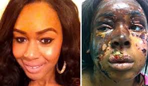 Image result for acid attack