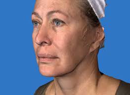 Facial Sculpting 3D Planning - Aesthetic Plastic Surgery by Lucian Ion, London - case1_1a