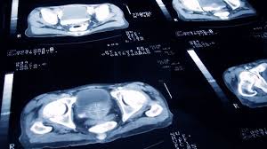 Focal Therapy Prostate Cancer Treatment