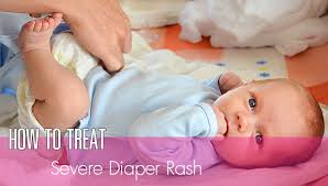 Image result for newborn diaper rash