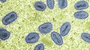 Severe Mpox Strain Identified in California