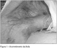 Resultado de imagem para sinais clinicos da síndrome de stevens johnson