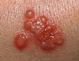 http://ginekologi.org/chlamydia