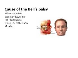Image result for bell's palsy