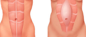 Képtalálat a következőre: „rectus diastasis”