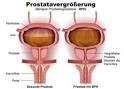 Häufiges Wasserlassen ist ein ernstzunehmendes Zeichen