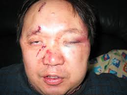 Dr. Li Yuan with 15 stitches for the wounds on his face after being beaten by gunmen in his own home on Feb. 8. The Course of the Attack - 2006-2-9-liyuan-02