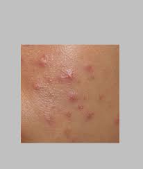 Image result for Pimples,