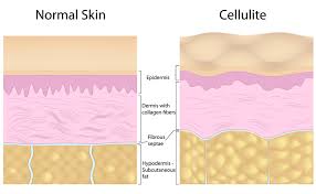 Image result for cellulite
