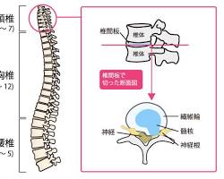 頚椎椎間板ヘルニアの画像