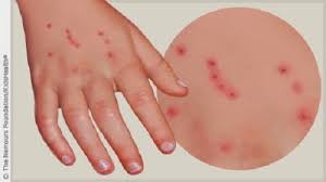 Resultado de imagen para picadura de garrapata