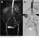 Leriche-Syndrom - Chirurgie Portal