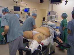 Image result for obesity patients