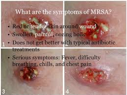 Image result for mrsa