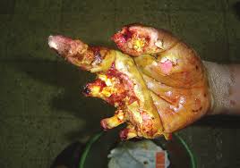 Image result for bomb explosion trauma surgery