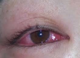 Image result for kanker