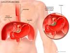 Cancer gastrique symptomes