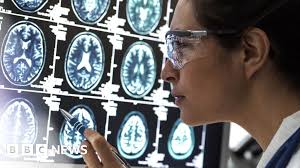 Drug slows cognitive decline in Alzheimer’s patients, study reveals