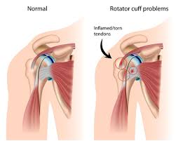 Image result for shoulder injuries