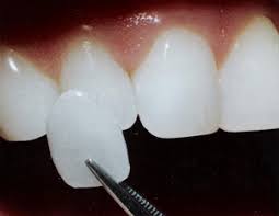 Image result for google images dental veneers